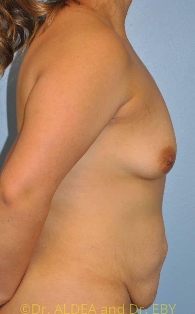 Before Image: Mommy Makeover #661 - right-side