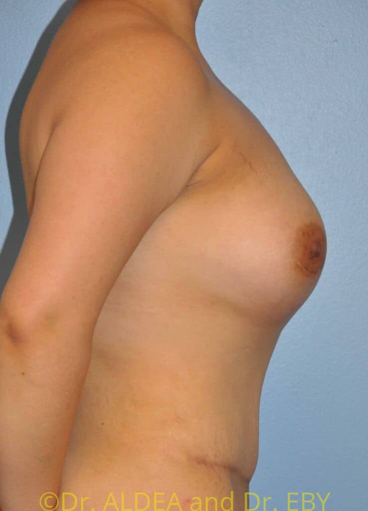 After Image: Mommy Makeover #661 - right-side