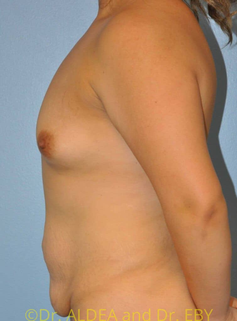Before Image: Mommy Makeover #661 - left-side