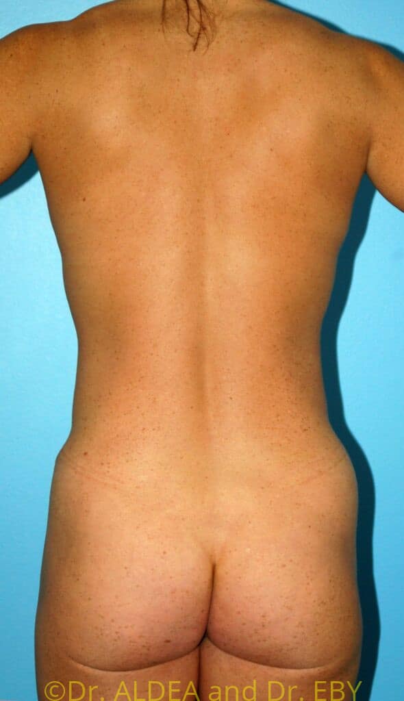 After Image: Tummy Tuck #207 - back