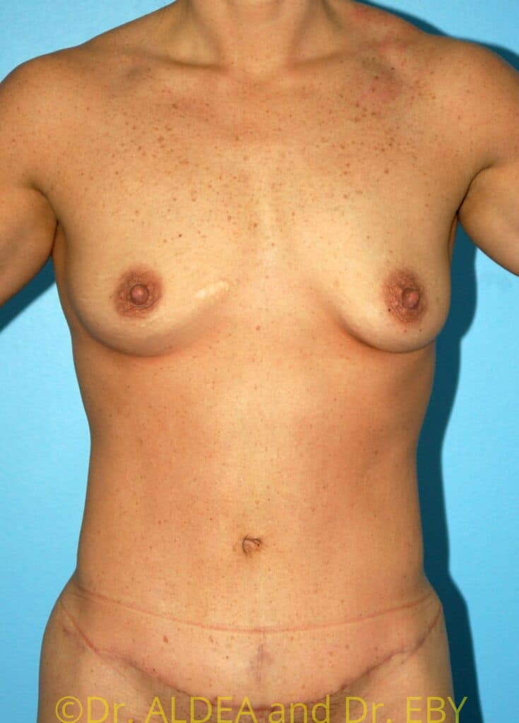 After Image: Tummy Tuck #207 - front