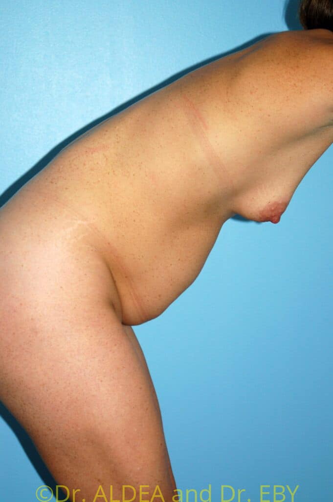 Before Image: Tummy Tuck #207 - other