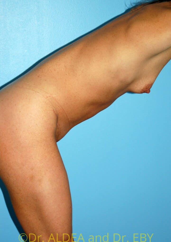 After Image: Tummy Tuck #207 - other