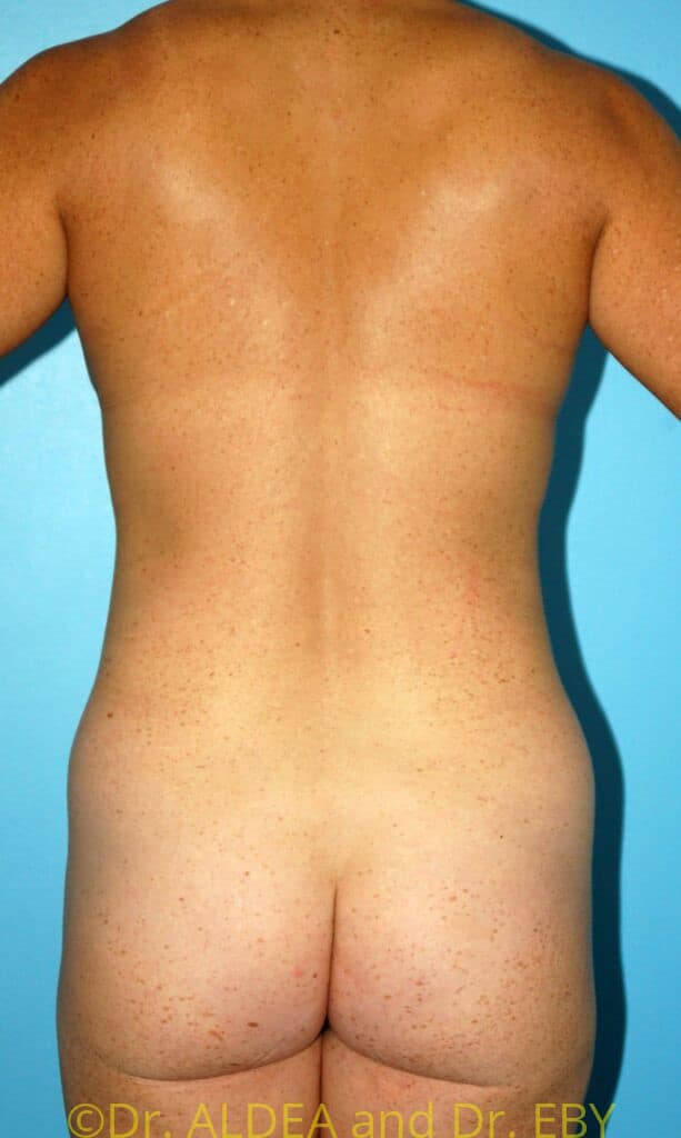 Before Image: Tummy Tuck #207 - back