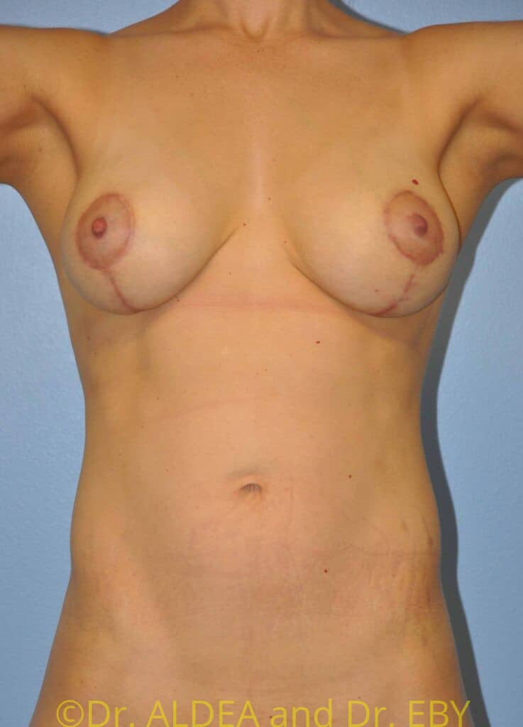 After Image: Breast Augmentation w/ Lift #378 - front