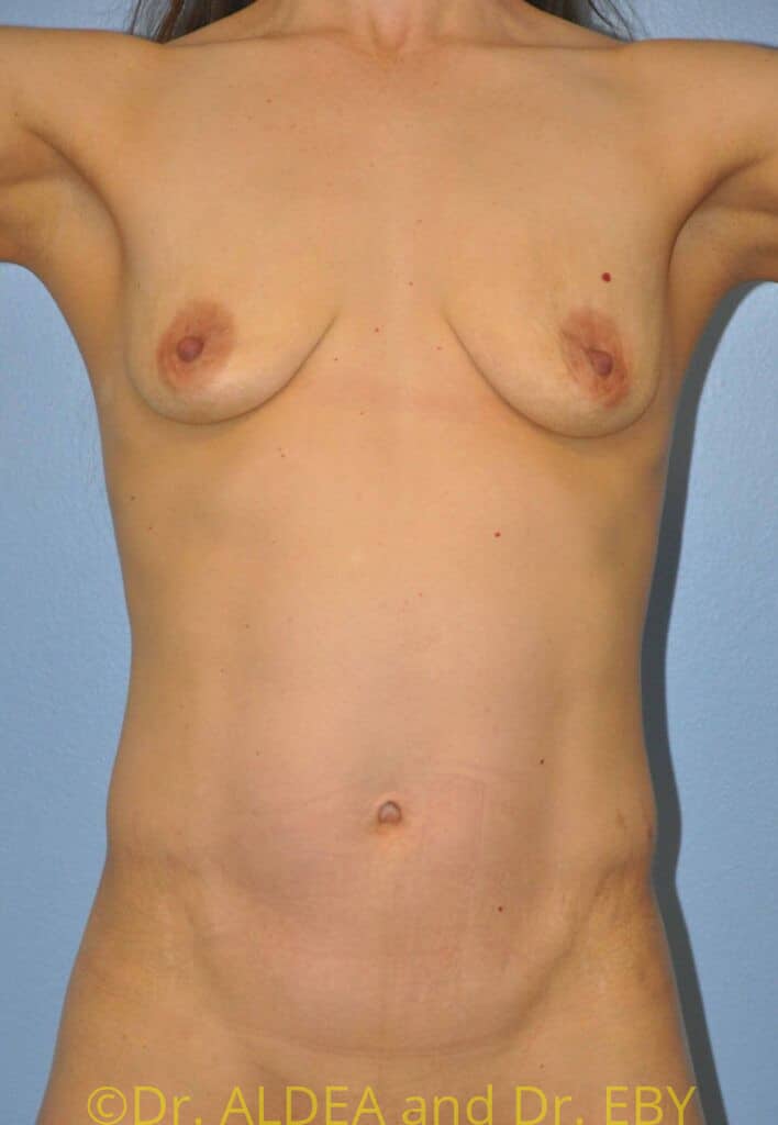 Before Image: Breast Augmentation w/ Lift #378 - front