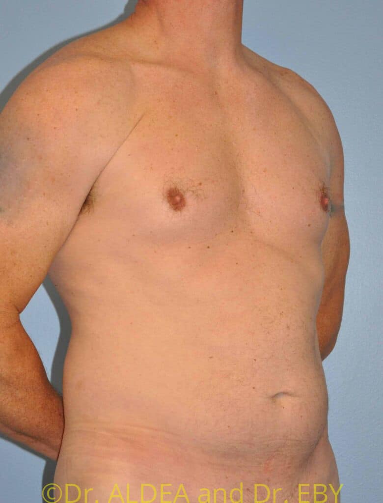 Before Image: Liposuction #526 - right-front-oblique