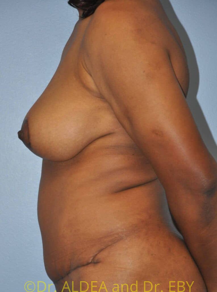 After Image: Mommy Makeover #846 - left-side