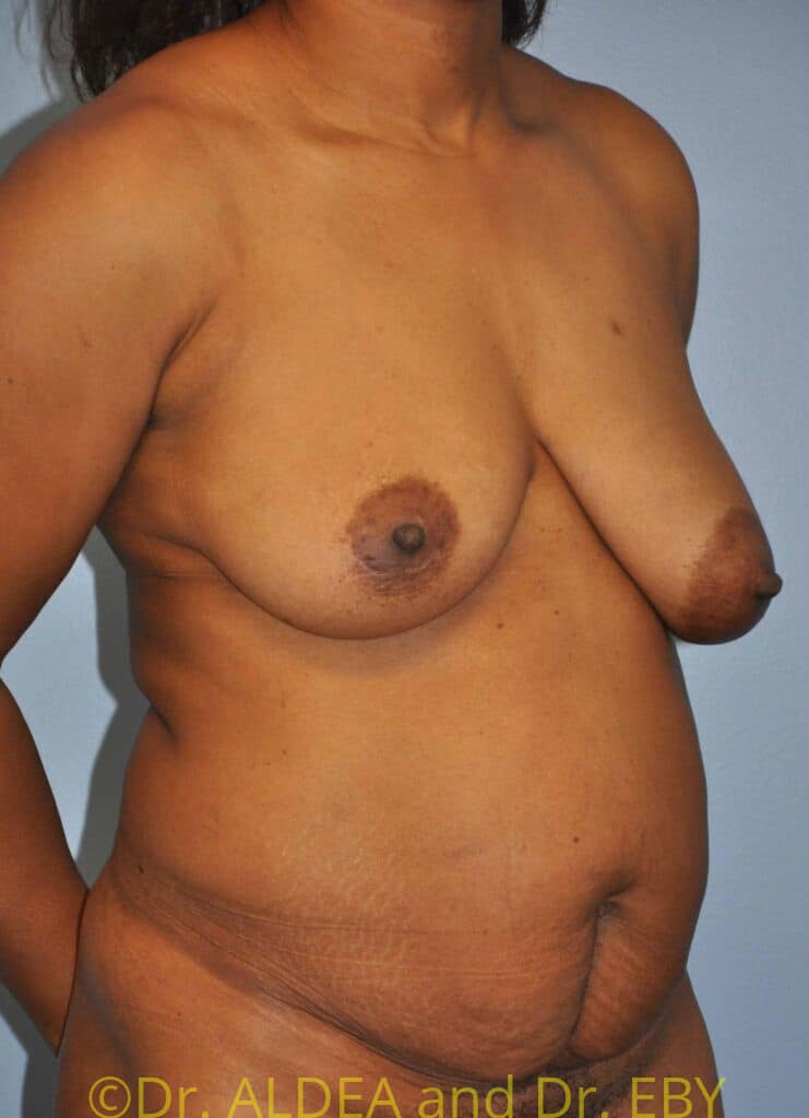 Before Image: Mommy Makeover #846 - right-front-oblique