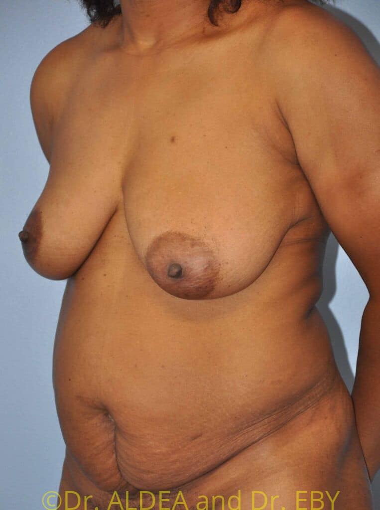 Before Image: Mommy Makeover #846 - left-front-oblique