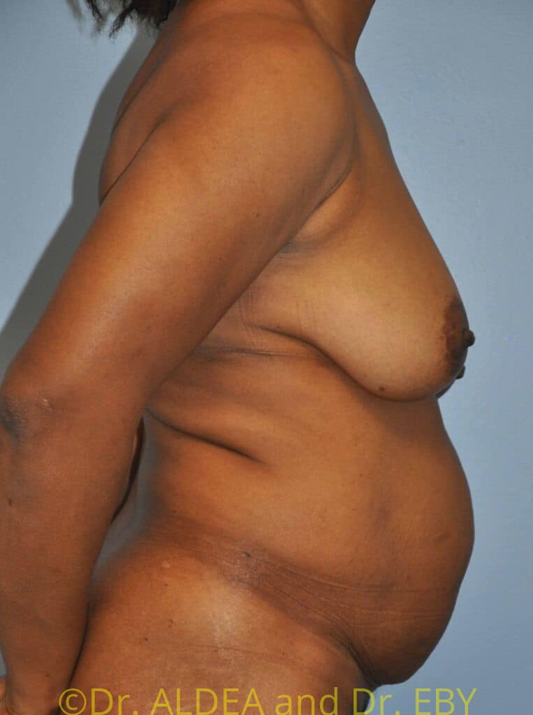 Before Image: Mommy Makeover #846 - right-side