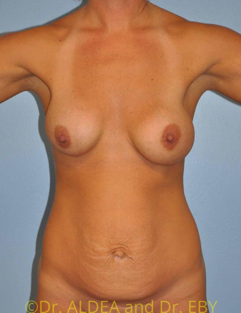 Before Image: Tummy Tuck #228 - front
