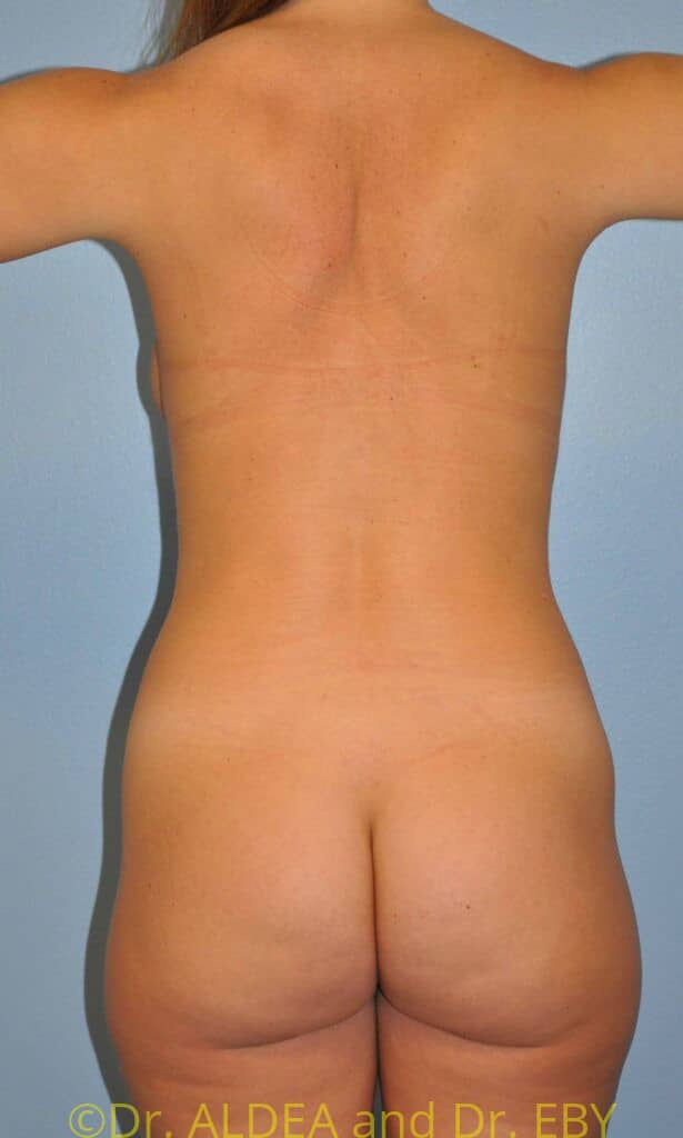 After Image: Tummy Tuck #228 - back