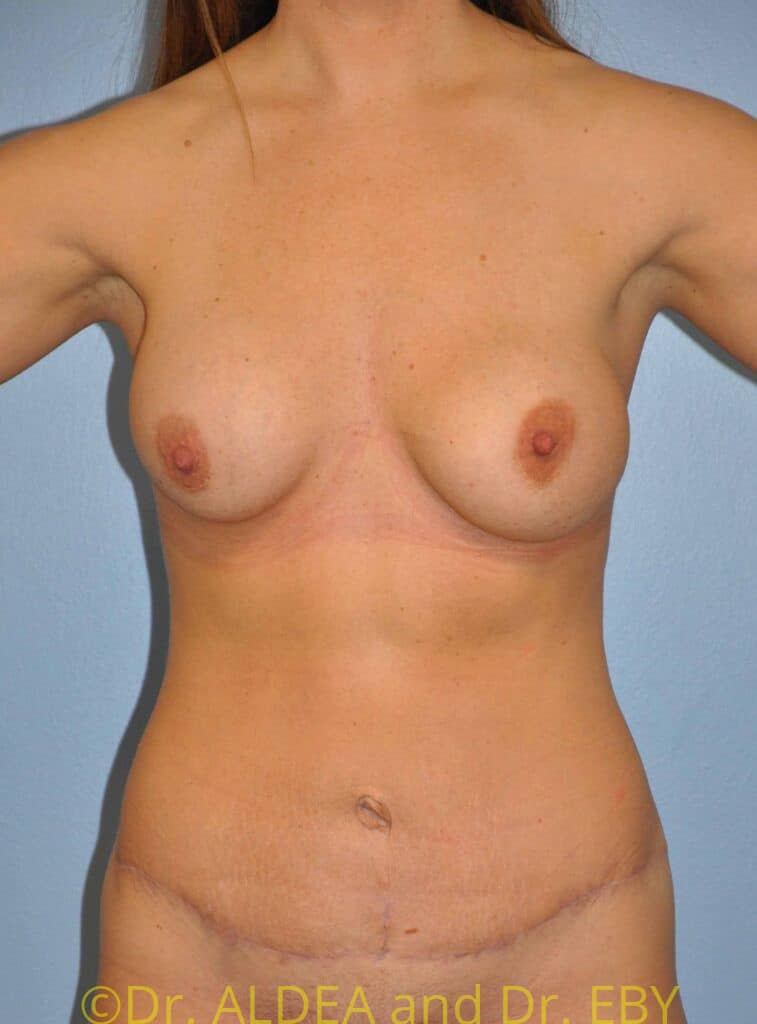 After Image: Tummy Tuck #228 - front