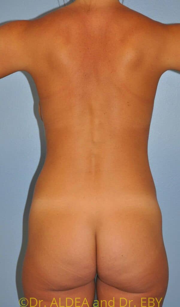 Before Image: Tummy Tuck #228 - back