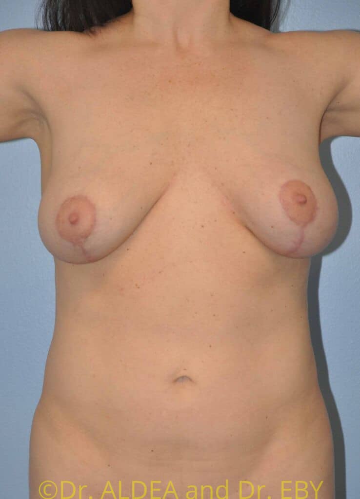 After Image: Breast Augmentation w/ Lift #868 - front