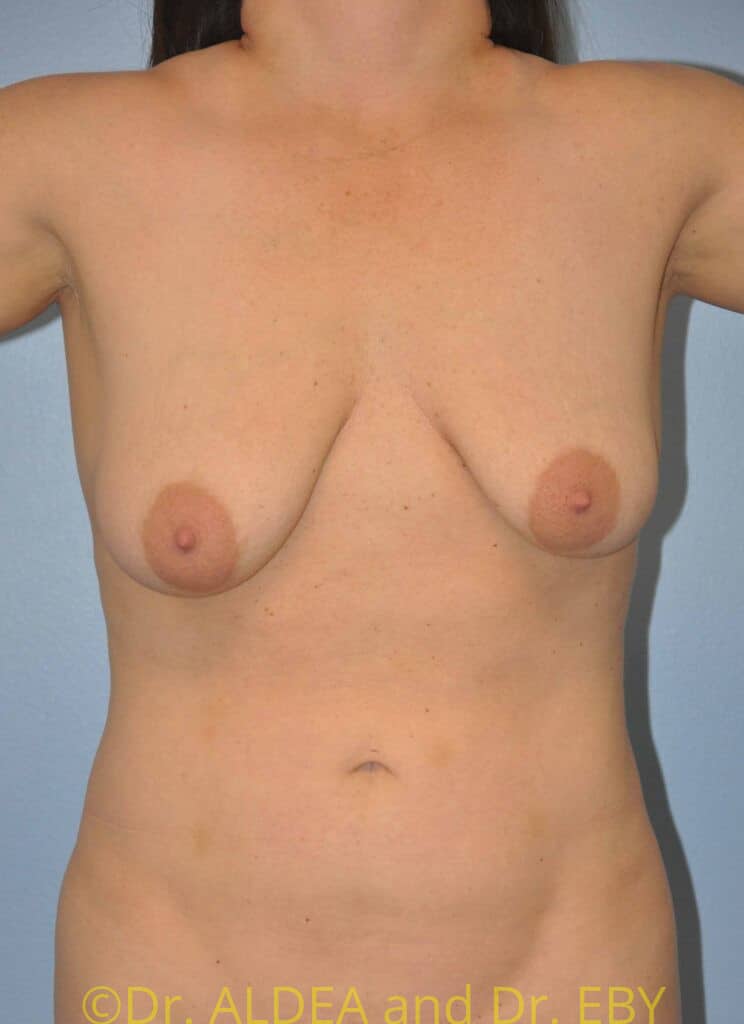 Before Image: Breast Augmentation w/ Lift #868 - front