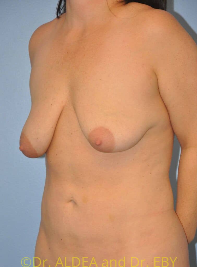 Before Image: Breast Augmentation w/ Lift #868 - left-front-oblique