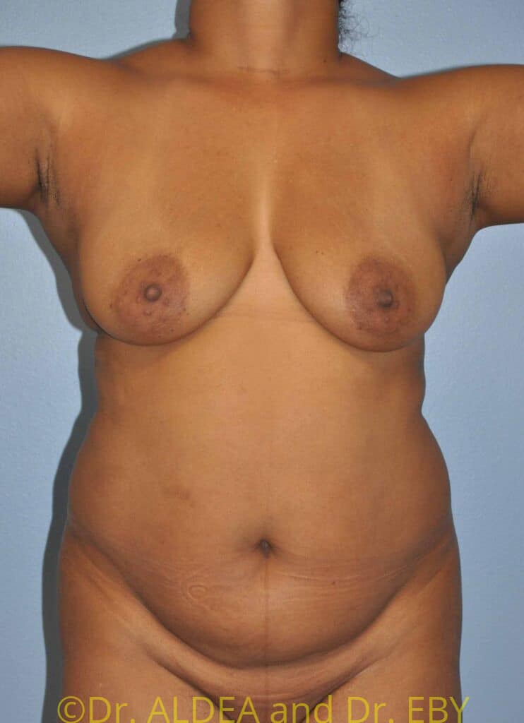 Before Image: Tummy Tuck #598 - front