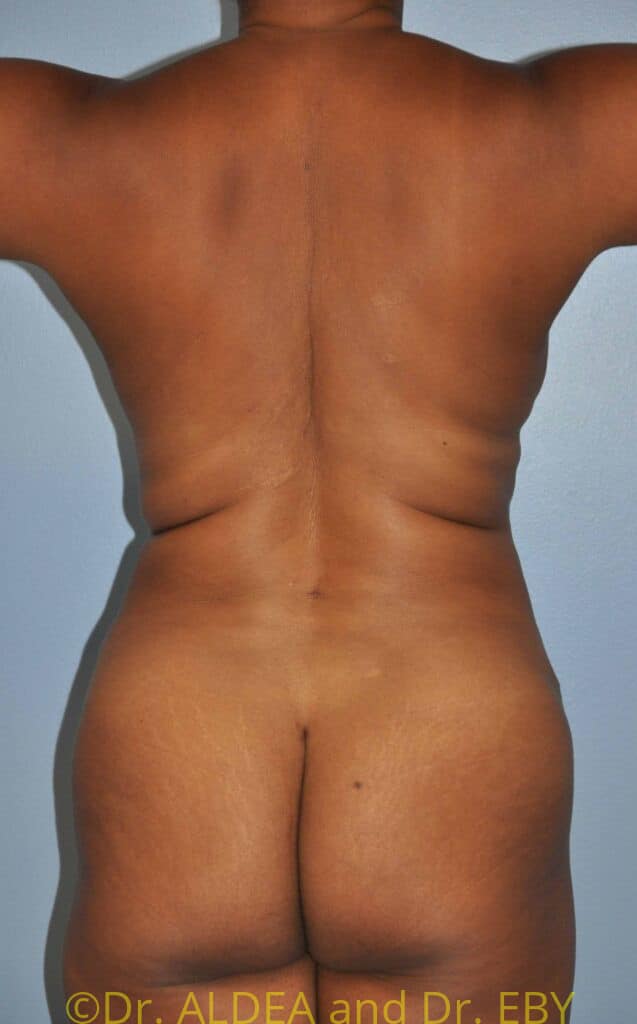 After Image: Tummy Tuck #598 - back