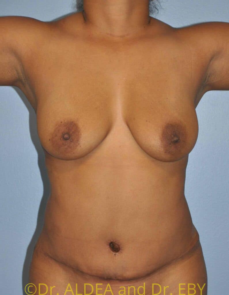 After Image: Tummy Tuck #598 - front