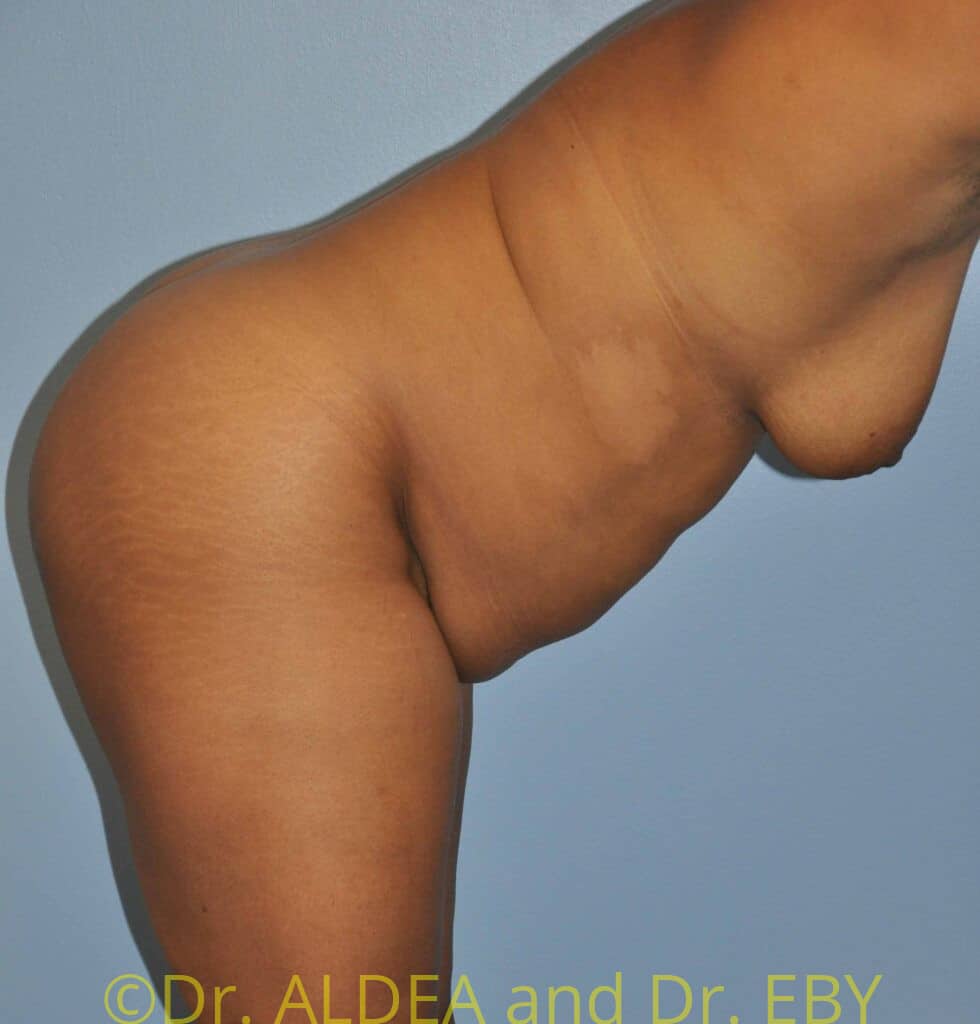Before Image: Tummy Tuck #598 - other