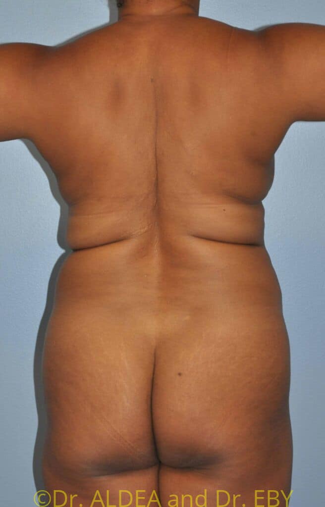 Before Image: Tummy Tuck #598 - back