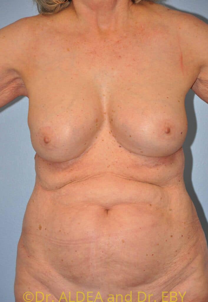 After Image: Breast Augmentation w/ Lift #556 - front