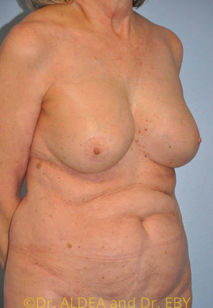 After Image: Breast Augmentation w/ Lift #556 - right-front-oblique