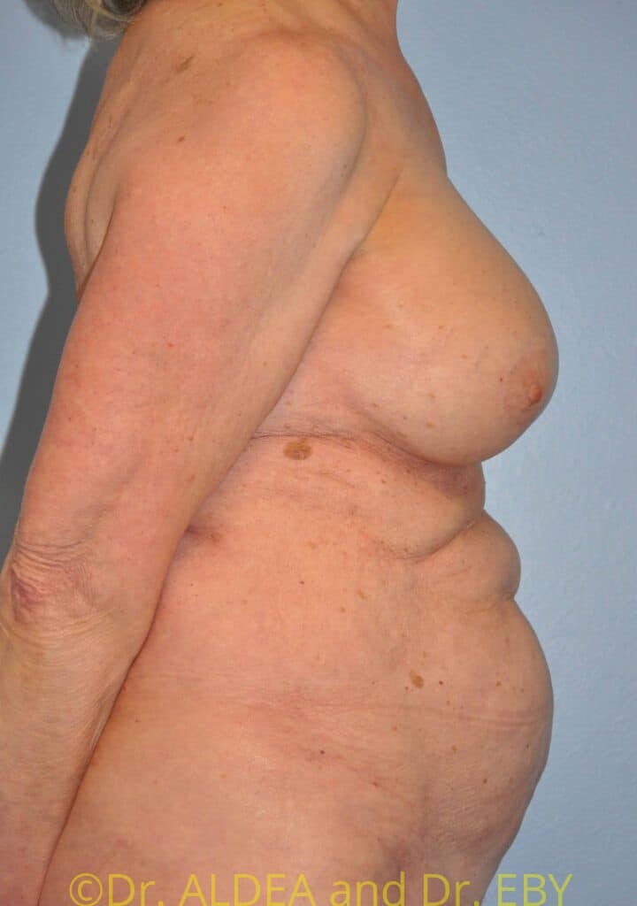 After Image: Breast Augmentation w/ Lift #556 - right-side