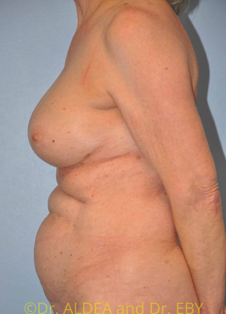 After Image: Breast Augmentation w/ Lift #556 - left-side