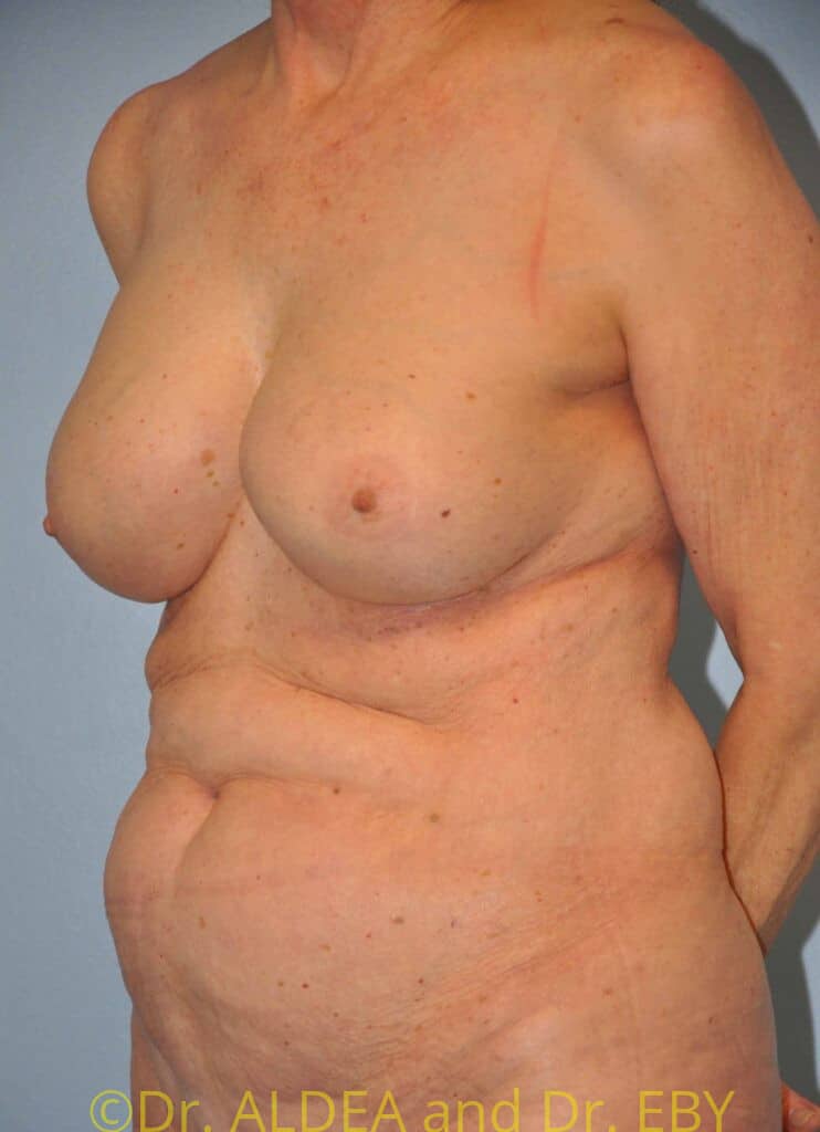 After Image: Breast Augmentation w/ Lift #556 - left-front-oblique