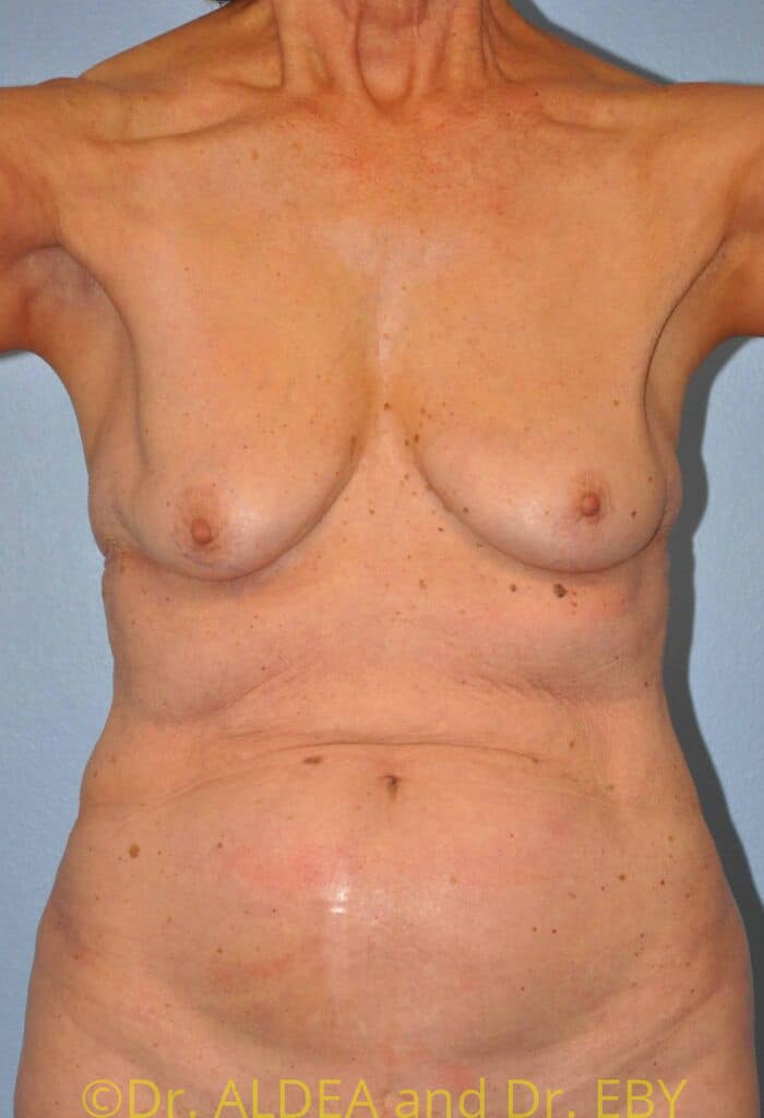 Before Image: Breast Augmentation w/ Lift #556 - front
