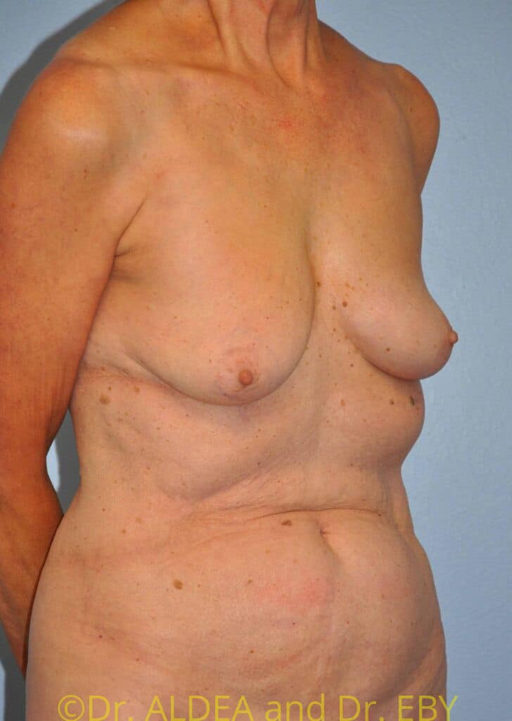 Before Image: Breast Augmentation w/ Lift #556 - right-front-oblique