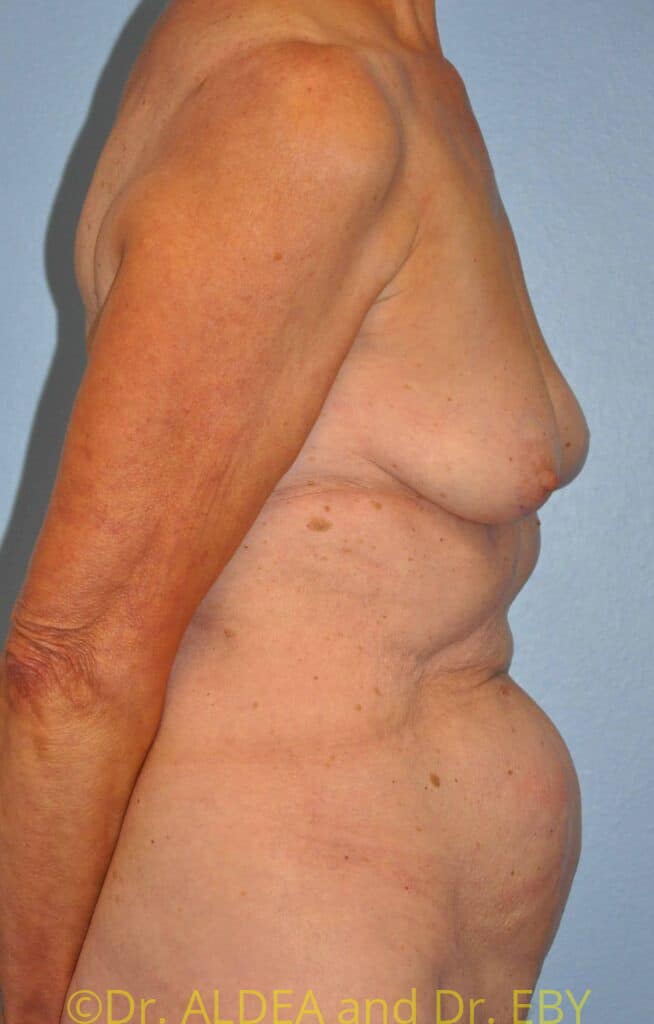 Before Image: Breast Augmentation w/ Lift #556 - right-side