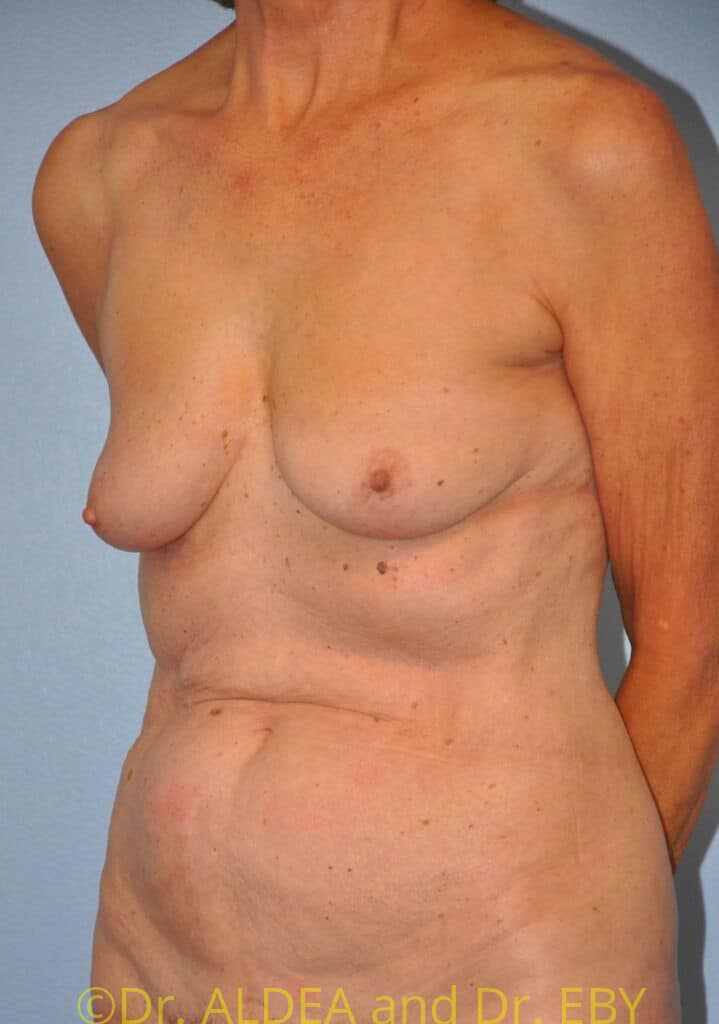 Before Image: Breast Augmentation w/ Lift #556 - left-front-oblique