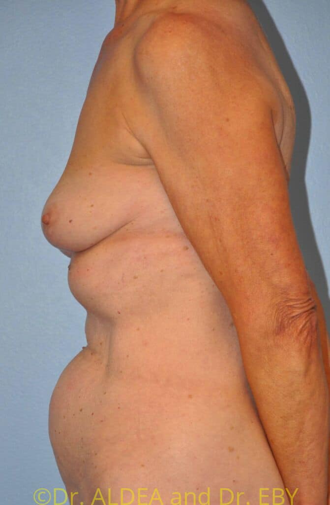 Before Image: Breast Augmentation w/ Lift #556 - left-side