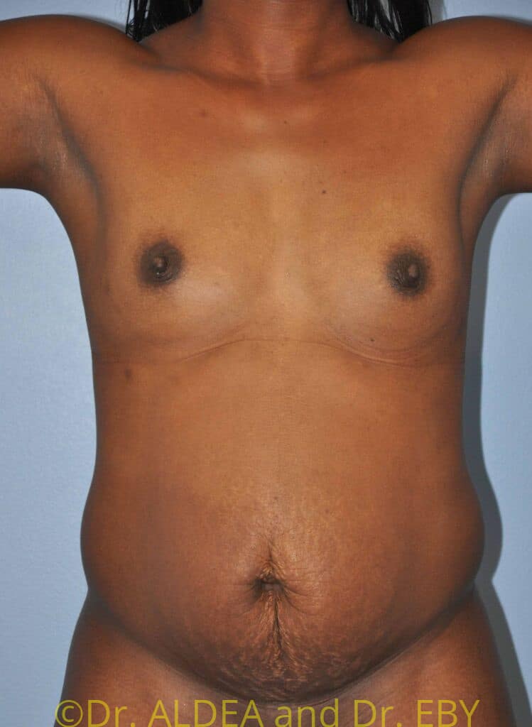 Before Image: Tummy Tuck #280 - front