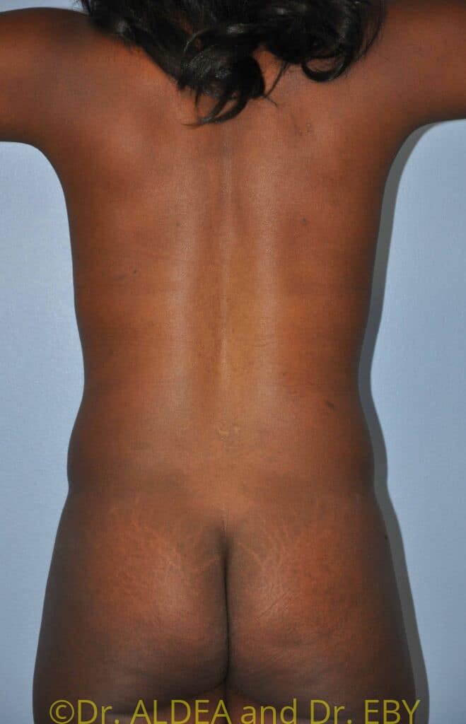 After Image: Tummy Tuck #280 - back
