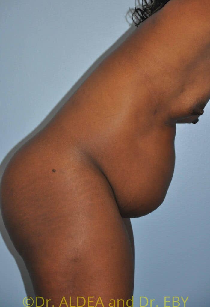 Before Image: Tummy Tuck #280 - other