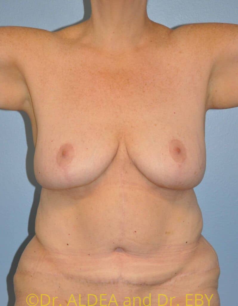 Before Image: Liposuction #837 - front