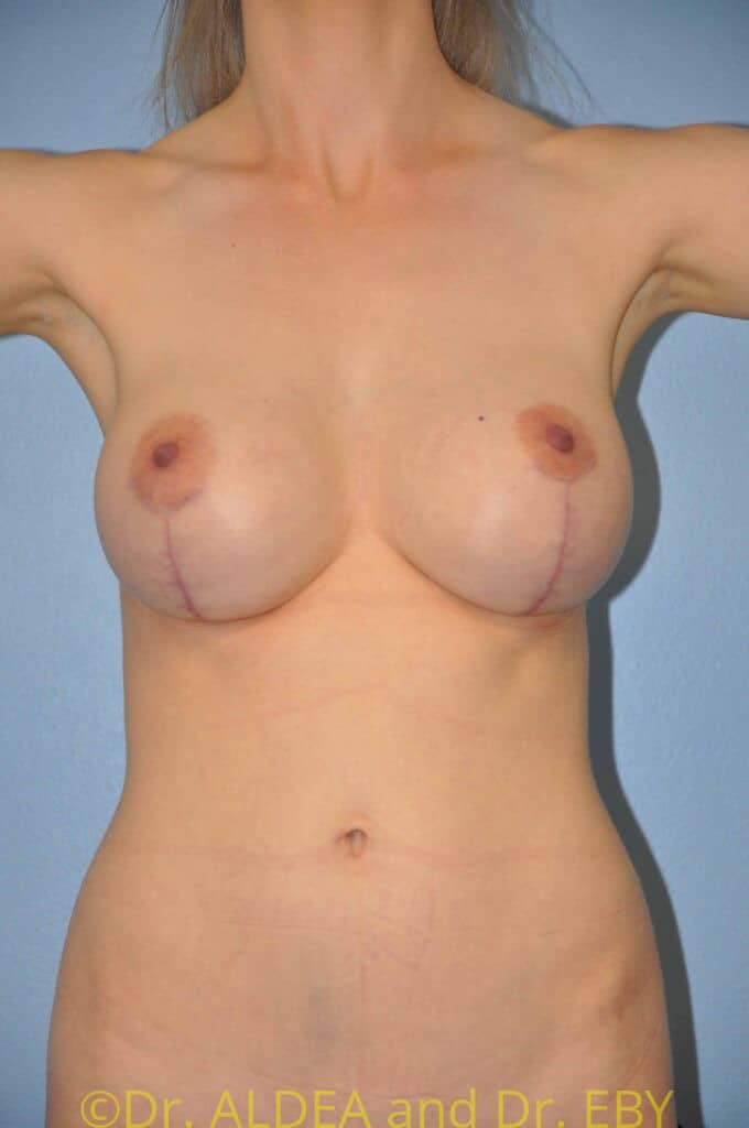 After Image: Breast Augmentation w/ Lift #915 - front