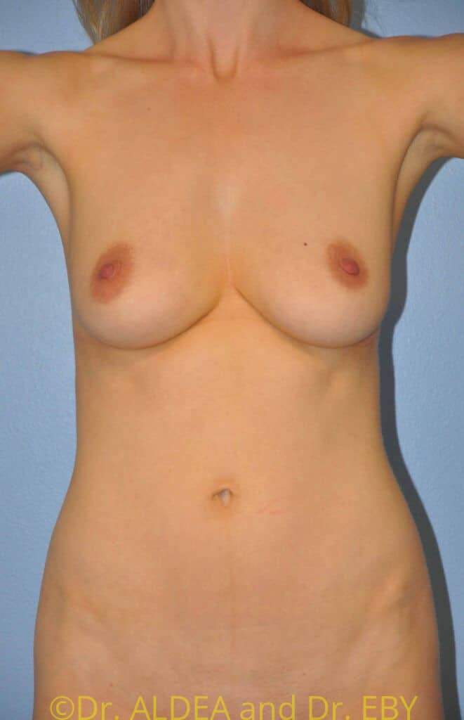Before Image: Breast Augmentation w/ Lift #915 - front