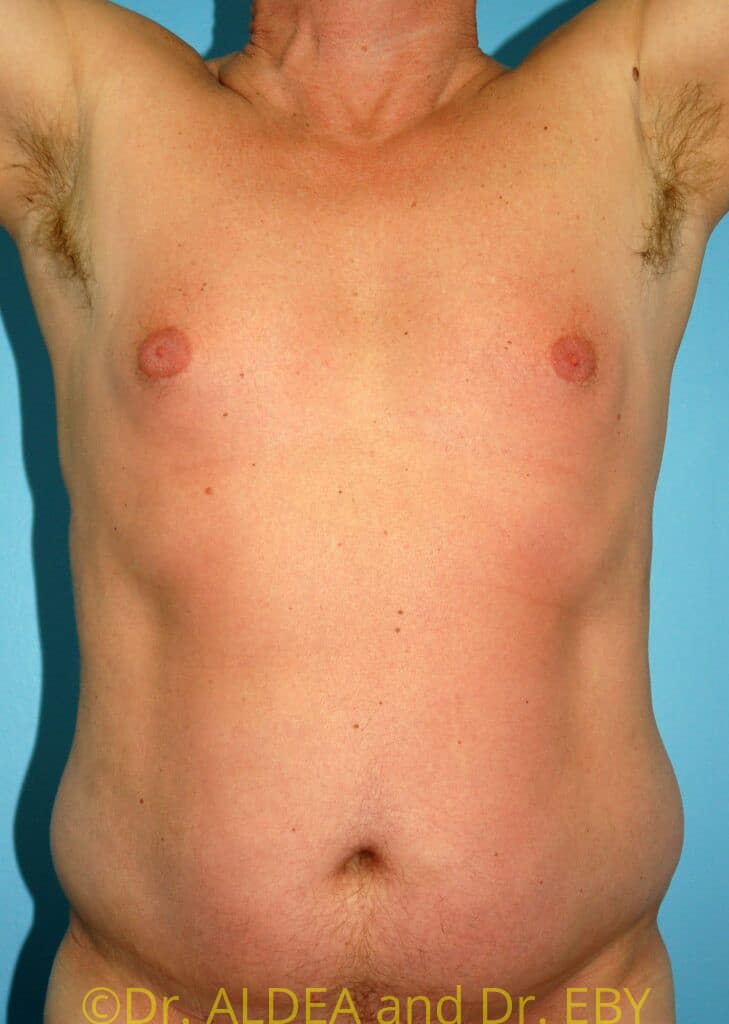 Before Image: Liposuction #458 - front