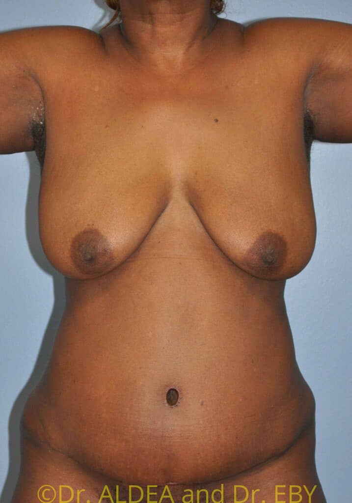 After Image: Tummy Tuck #224 - front
