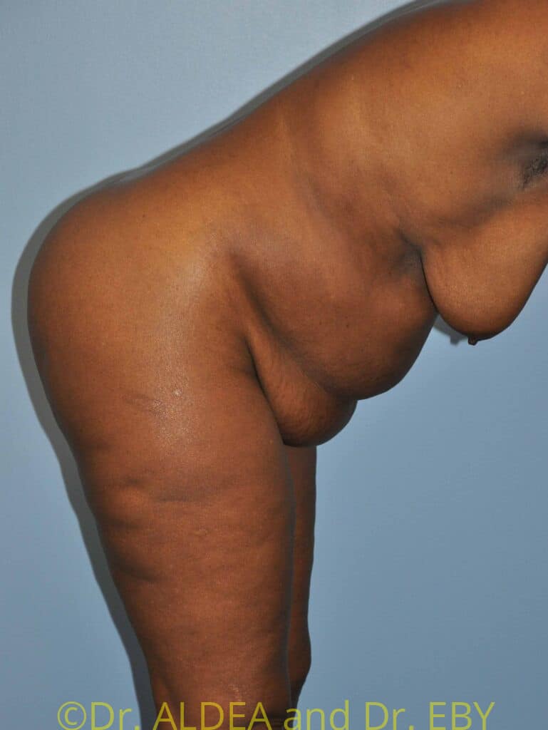 Before Image: Tummy Tuck #224 - other