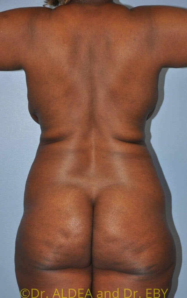 Before Image: Tummy Tuck #224 - back