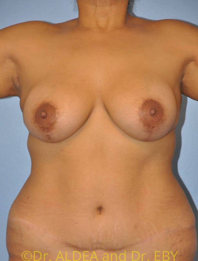 After Image: Breast Augmentation w/ Lift #509 - front