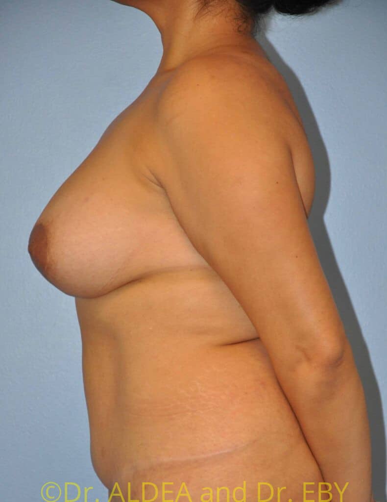 After Image: Breast Augmentation w/ Lift #509 - left-side