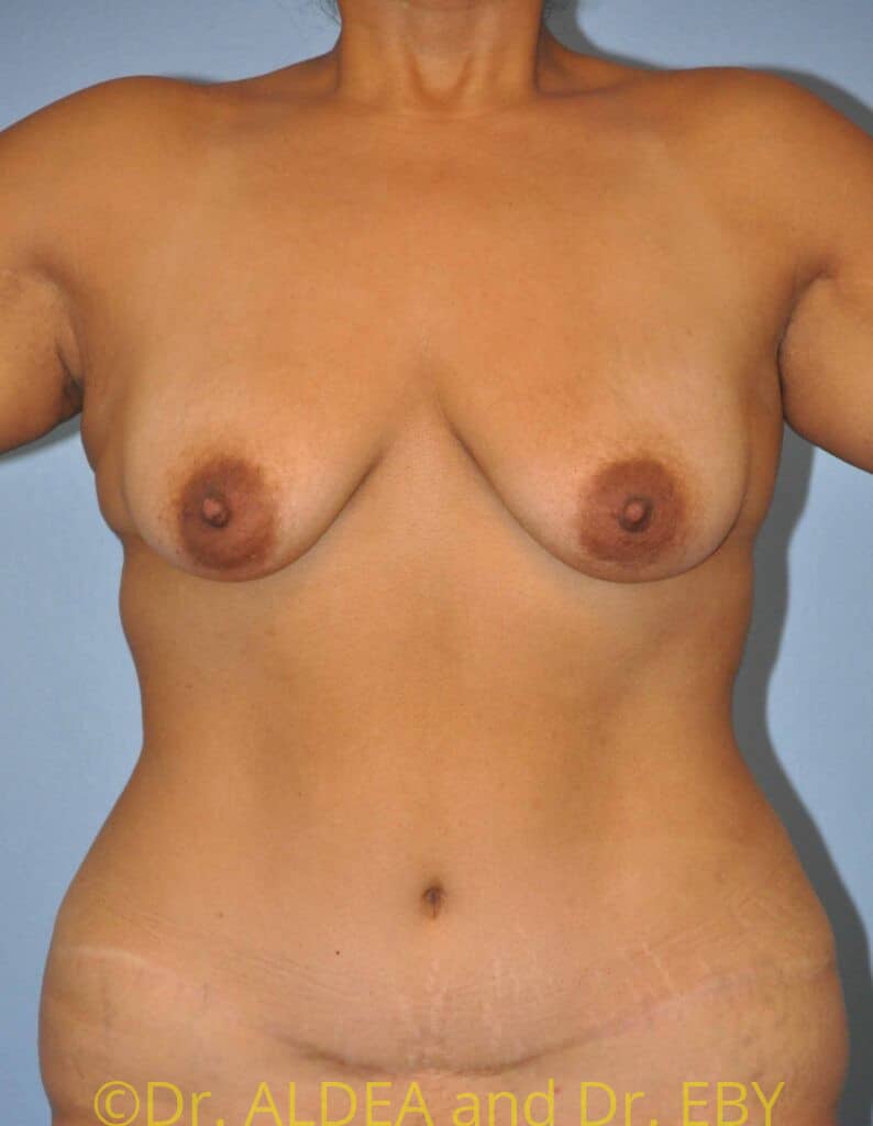 Before Image: Breast Augmentation w/ Lift #509 - front